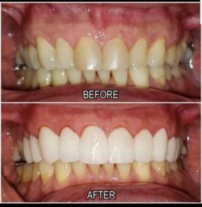 cosmetic treatment before and after