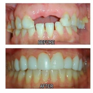 missing teeth before and after