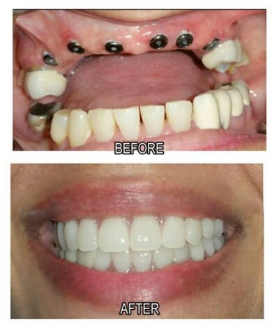 dental implant patient before and after
