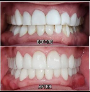 cosmetic dentistry before and after picture