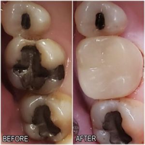 CEREC before and after
