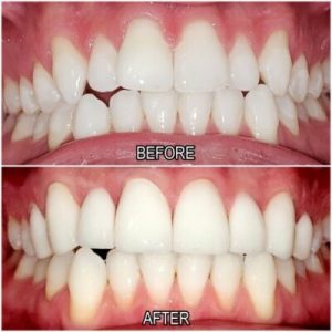 cosmetic dentistry patient before and after