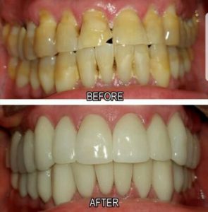 veneers before and after