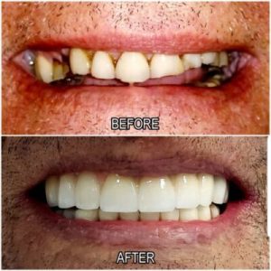 dental reconstruction before and after