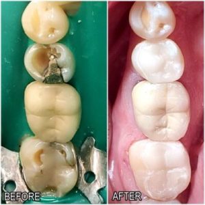 dental repair before and after