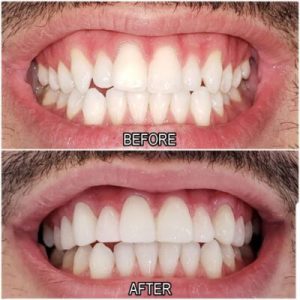porcelain veneers before and after