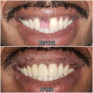 tooth replacement before and after