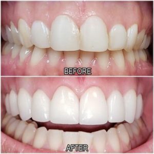 before and after dental treatment