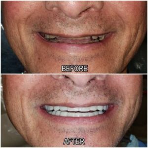 dental implant before and after