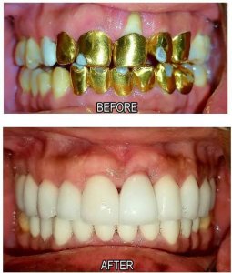 dental reconstruction before and after