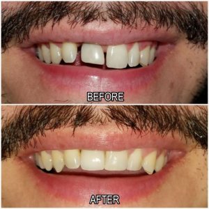 dental treatment before and after
