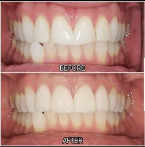 veneers before and after