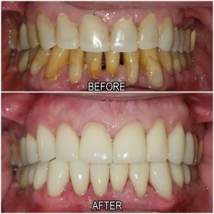 cosmetic dentistry before and after