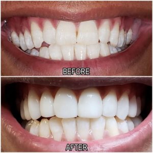 dental before and after
