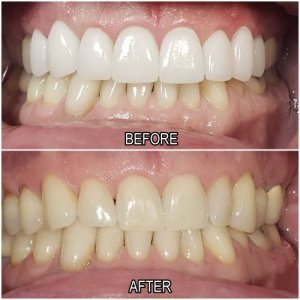 teeth whitening before and after