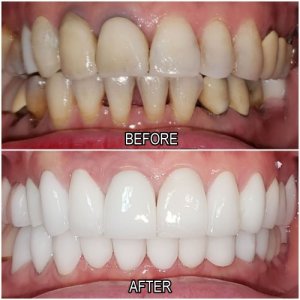 teeth whitening before and after