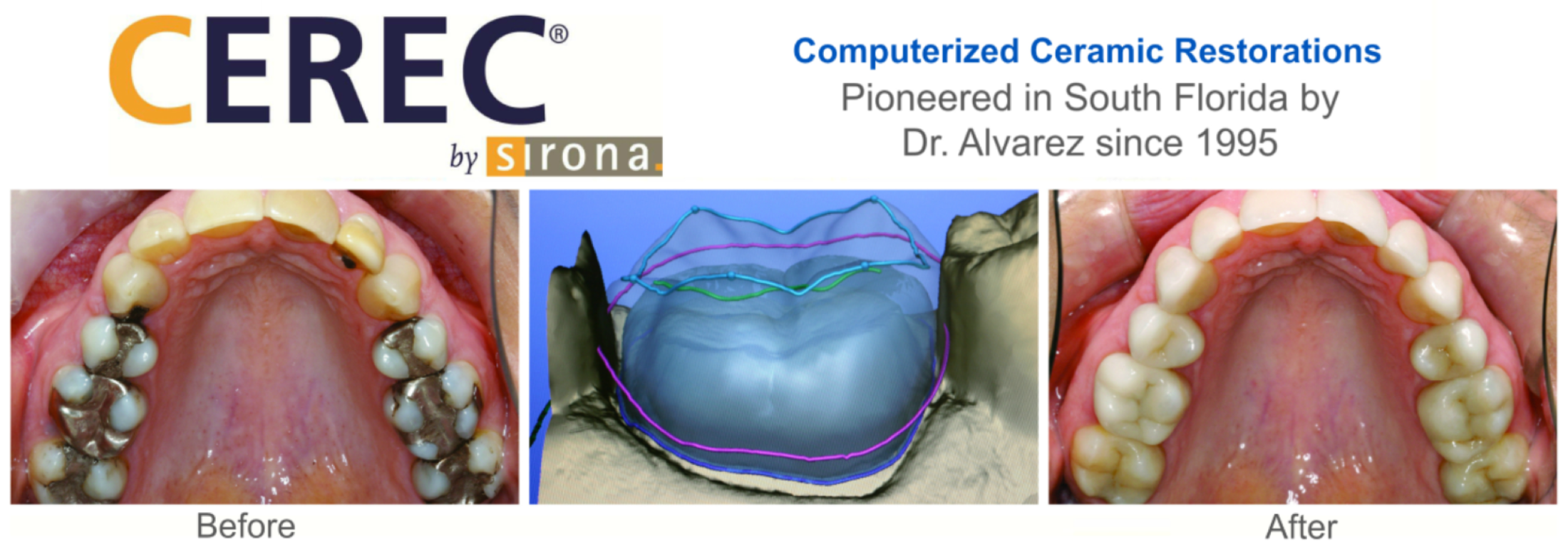 CEREC before and after