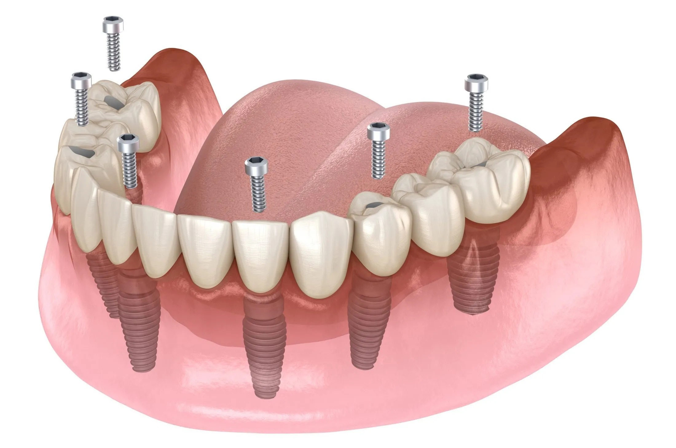 permanent dentures illustration